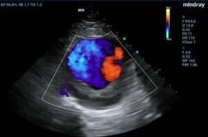 Fetal COlor Doppler