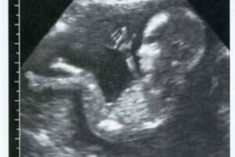 Fetal Ultrasonography